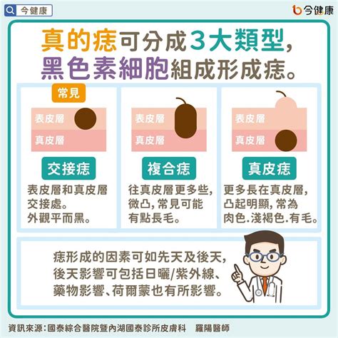 懷孕長痣|痣變大＝皮膚癌？醫曝「醜小鴨法則」看懂哪些痣最危。